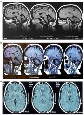 Incidentalome in Neurogenetics: Pathogenic Variant of NSD1 in a Patient With Spinocerebellar Ataxia (SCA)